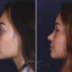 Rhinoplasty before and after photos in Voorhees, NJ, Patient 91