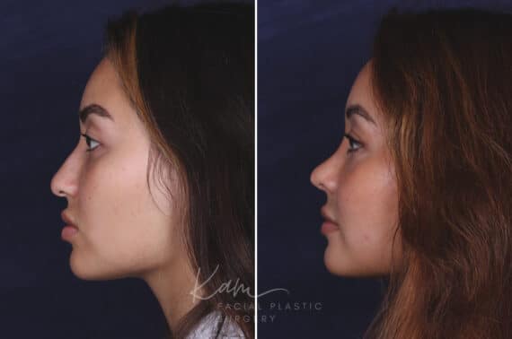 Rhinoplasty before and after photos in Voorhees, NJ, Patient 91