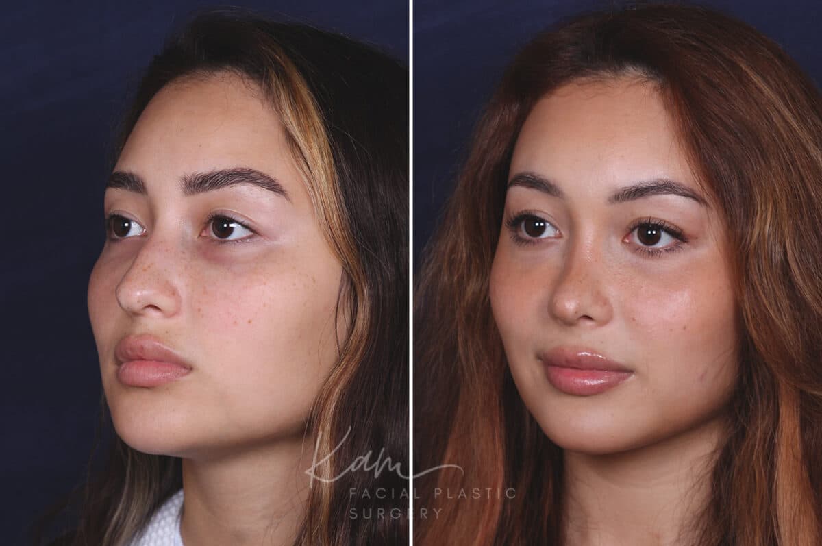 Rhinoplasty before and after photos in Voorhees, NJ, Patient 91