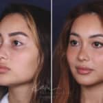 Rhinoplasty before and after photos in Voorhees, NJ, Patient 91