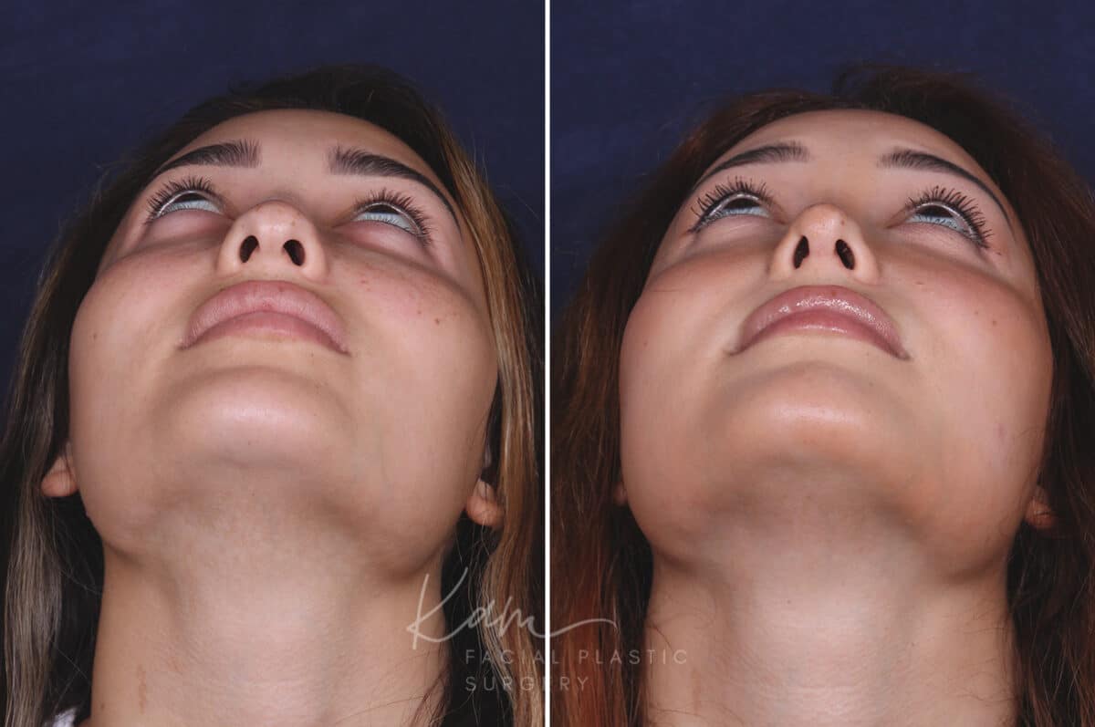 Rhinoplasty before and after photos in Voorhees, NJ, Patient 91