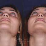 Rhinoplasty before and after photos in Voorhees, NJ, Patient 91