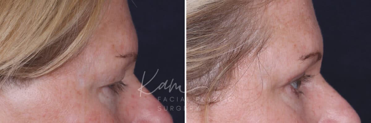 Upper Blepharoplasty before and after photos in Voorhees, NJ, Patient 932