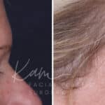Upper Blepharoplasty before and after photos in Voorhees, NJ, Patient 932