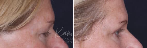 Upper Blepharoplasty before and after photos in Voorhees, NJ, Patient 932