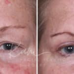 Upper Blepharoplasty before and after photos in Voorhees, NJ, Patient 932