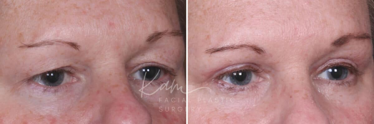 Upper Blepharoplasty before and after photos in Voorhees, NJ, Patient 932