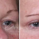 Upper Blepharoplasty before and after photos in Voorhees, NJ, Patient 932