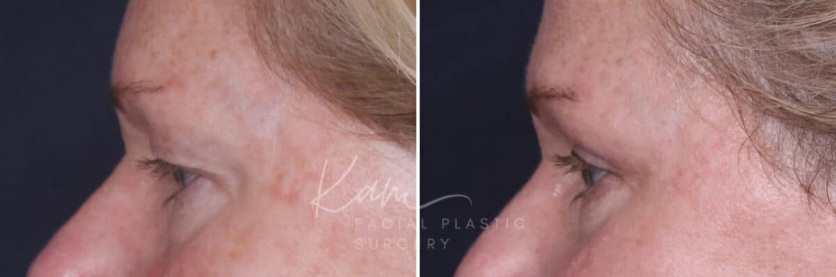 Upper Blepharoplasty before and after photos in Voorhees, NJ, Patient 932