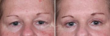 Upper Blepharoplasty before and after photos in Voorhees, NJ, Patient 932