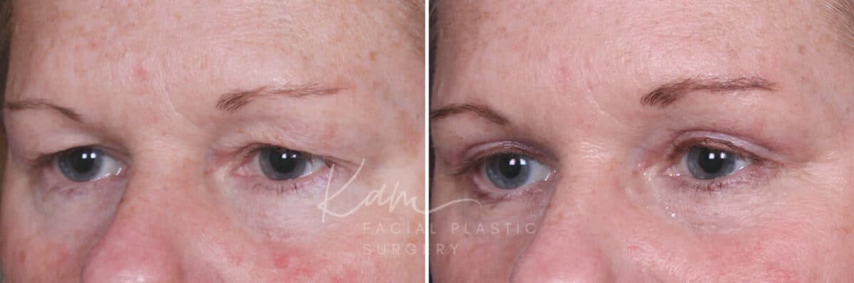 Upper Blepharoplasty before and after photos in Voorhees, NJ, Patient 932