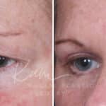 Upper Blepharoplasty before and after photos in Voorhees, NJ, Patient 932