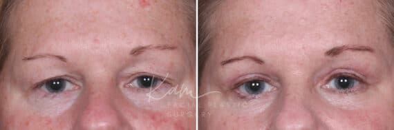 Upper Blepharoplasty before and after photos in Voorhees, NJ, Patient 932