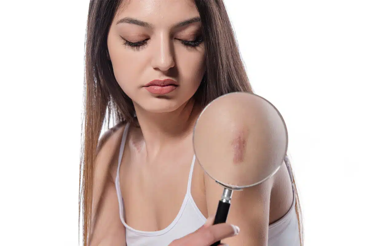 Discover How to Remove Unwanted Scars with Scar Tissue Removal