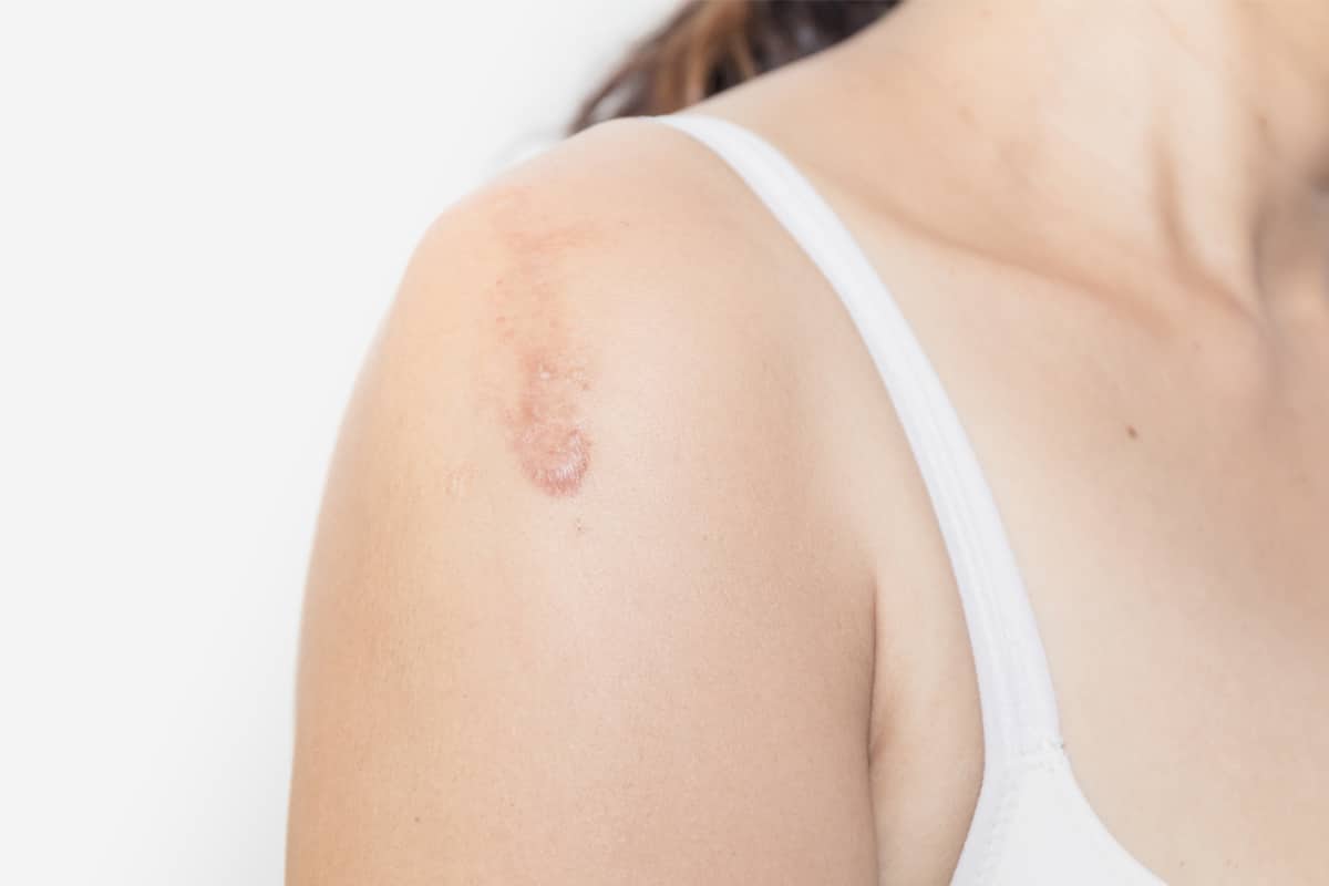 Flap Surgery for Scar Revision: What You Need to Know