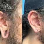 Otoplasty before and after photos in Voorhees, NJ, Patient 1505