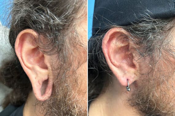 Otoplasty before and after photos in Voorhees, NJ, Patient 1505