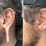 Otoplasty before and after photos in Voorhees, NJ, Patient 1505