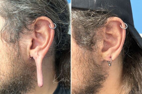 Otoplasty before and after photos in Voorhees, NJ, Patient 1505