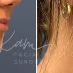 Injectable Treatments before and after photos in Voorhees, NJ, Patient 1508
