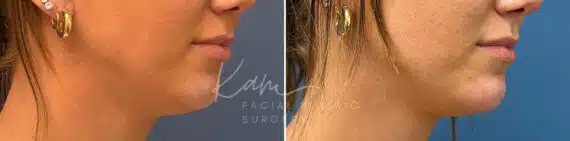 Injectable Treatments before and after photos in Voorhees, NJ, Patient 1508
