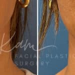 Injectable Treatments before and after photos in Voorhees, NJ, Patient 1508