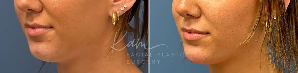 Injectable Treatments before and after photos in Voorhees, NJ, Patient 1508