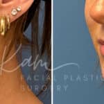 Injectable Treatments before and after photos in Voorhees, NJ, Patient 1508