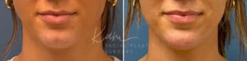 Injectable Treatments before and after photos in Voorhees, NJ, Patient 1508