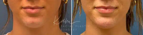 Injectable Treatments before and after photos in Voorhees, NJ, Patient 1508