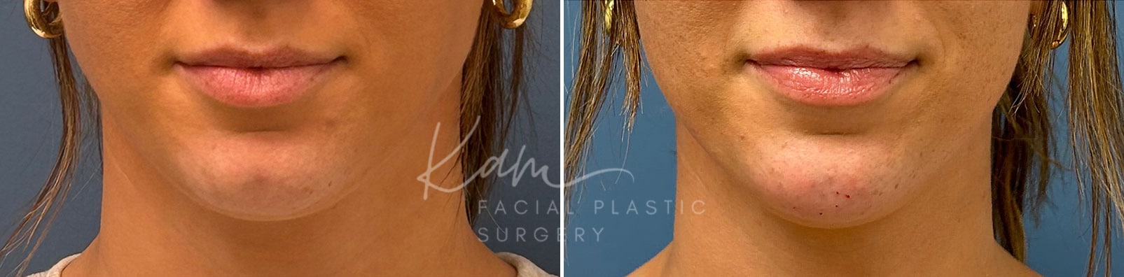 Injectable Treatments before and after photos in Voorhees, NJ, Patient 1508