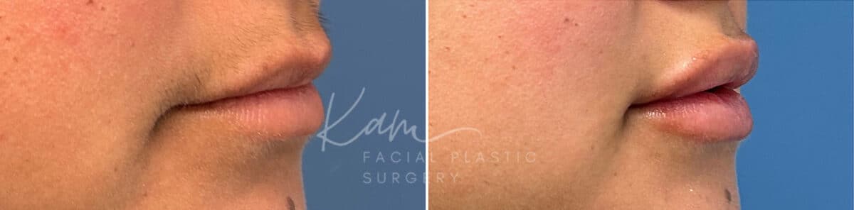 Injectable Treatments before and after photos in Voorhees, NJ, Patient 1512