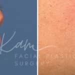 Injectable Treatments before and after photos in Voorhees, NJ, Patient 1512