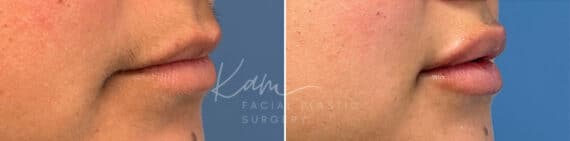 Injectable Treatments before and after photos in Voorhees, NJ, Patient 1512
