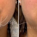 Injectable Treatments before and after photos in Voorhees, NJ, Patient 1512