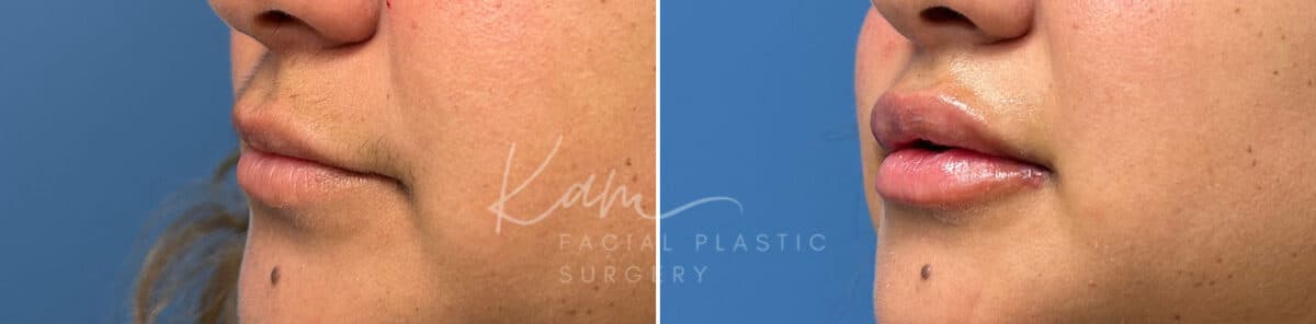 Injectable Treatments before and after photos in Voorhees, NJ, Patient 1512