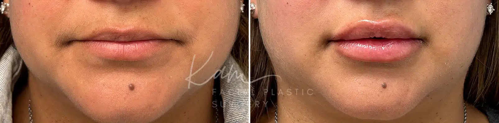 Injectable Treatments before and after photos in Voorhees, NJ, Patient 1512