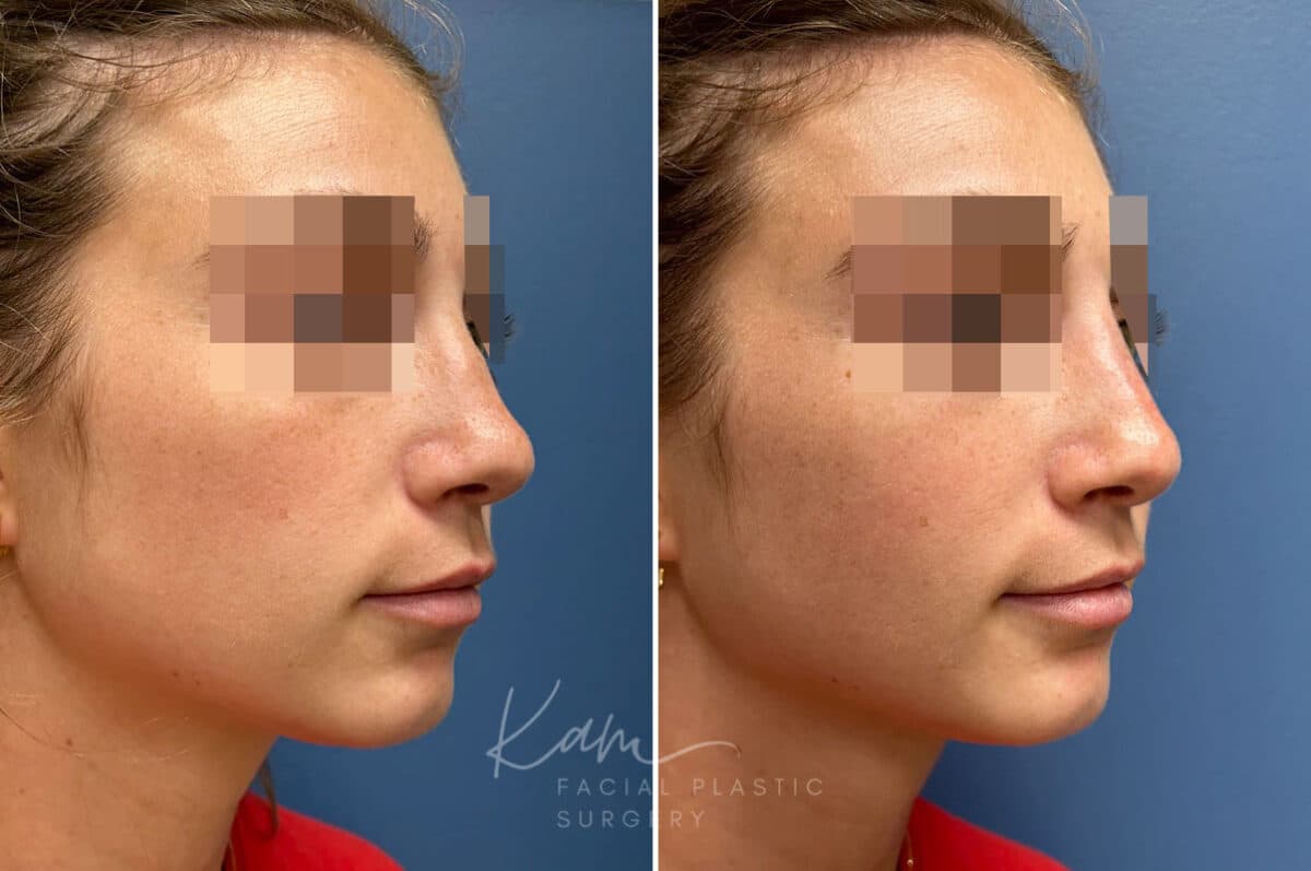 Liquid Rhinoplasty before and after photos in Voorhees, NJ, Patient 1517