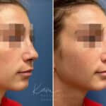 Liquid Rhinoplasty before and after photos in Voorhees, NJ, Patient 1517