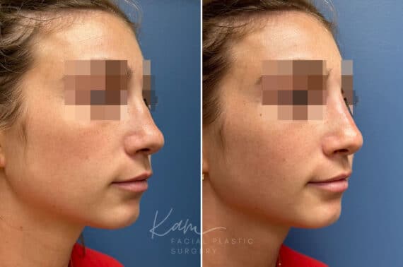 Liquid Rhinoplasty before and after photos in Voorhees, NJ, Patient 1517
