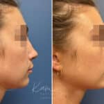 Liquid Rhinoplasty before and after photos in Voorhees, NJ, Patient 1517