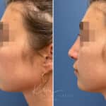 Liquid Rhinoplasty before and after photos in Voorhees, NJ, Patient 1517