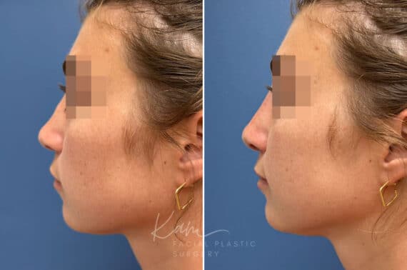 Liquid Rhinoplasty before and after photos in Voorhees, NJ, Patient 1517