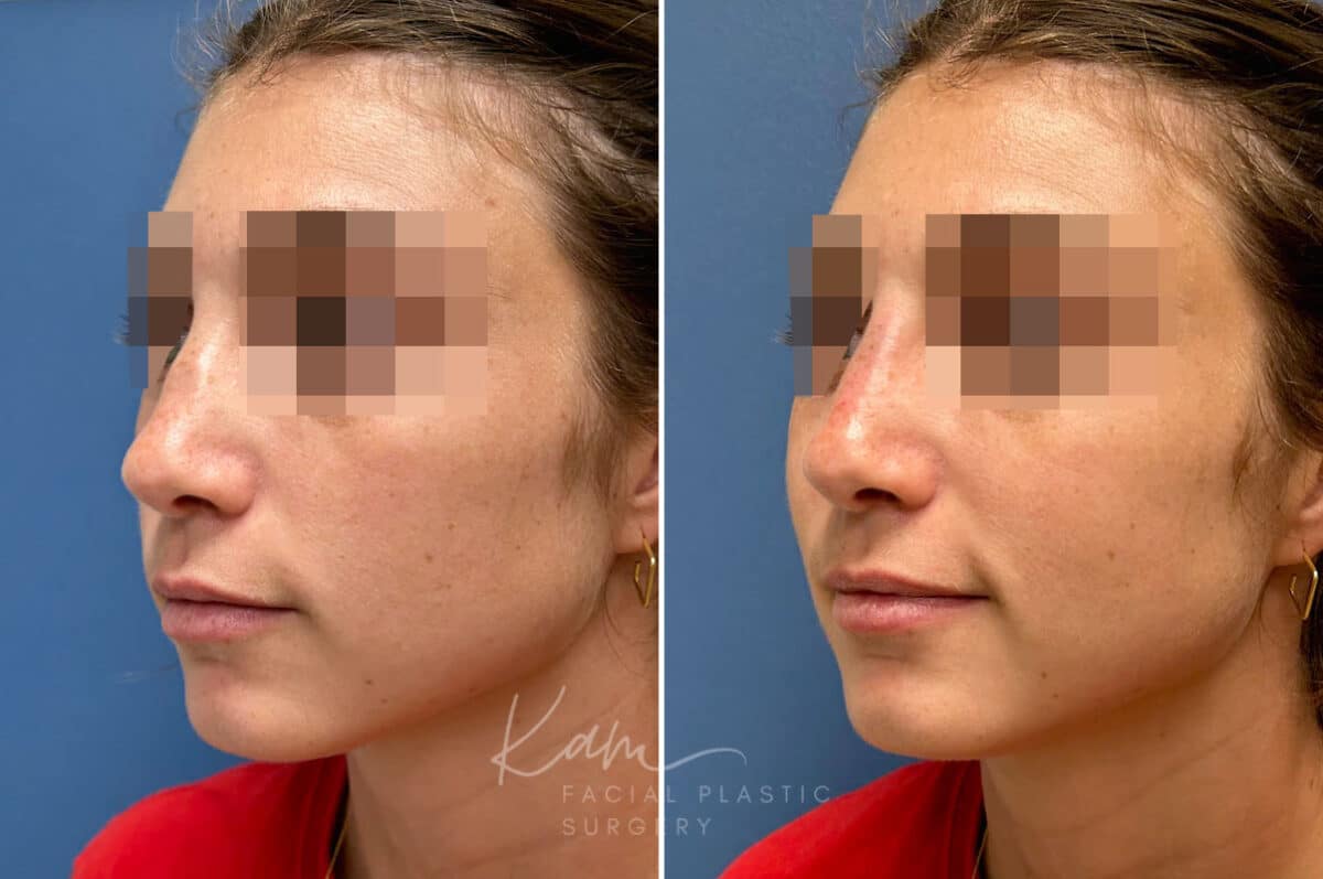 Liquid Rhinoplasty before and after photos in Voorhees, NJ, Patient 1517