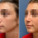 Liquid Rhinoplasty before and after photos in Voorhees, NJ, Patient 1517