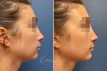 Liquid Rhinoplasty before and after photos in Voorhees, NJ, Patient 1517