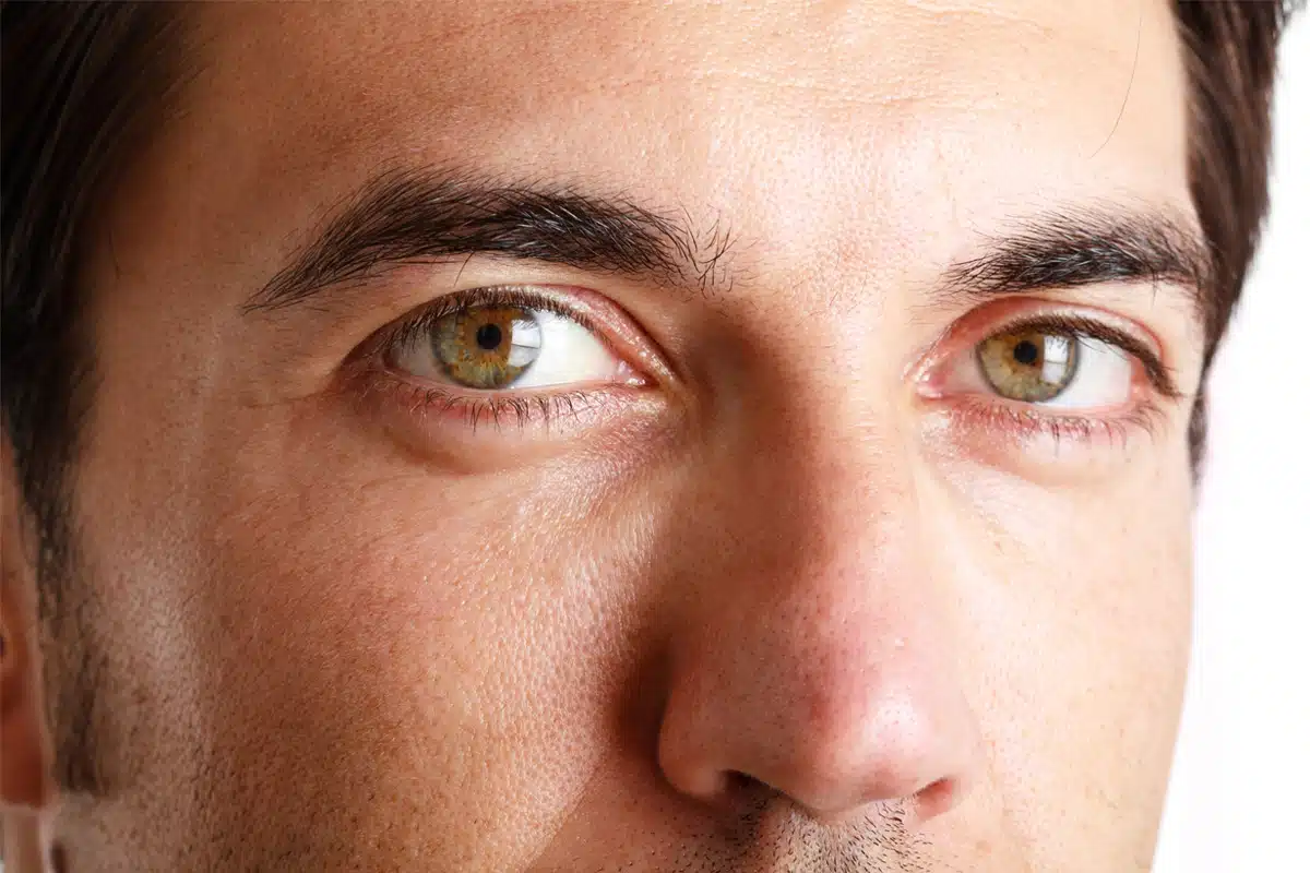Navigating Rhinophyma Surgery: What Patients Need to Know