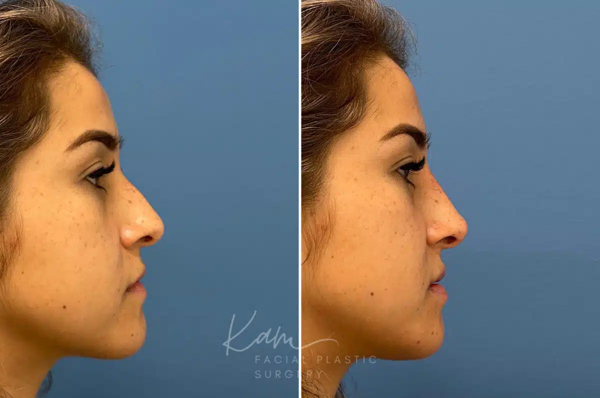 Liquid Rhinoplasty before and after photos in Voorhees, NJ, Patient 1884