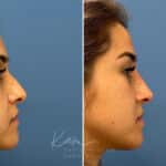 Liquid Rhinoplasty before and after photos in Voorhees, NJ, Patient 1884
