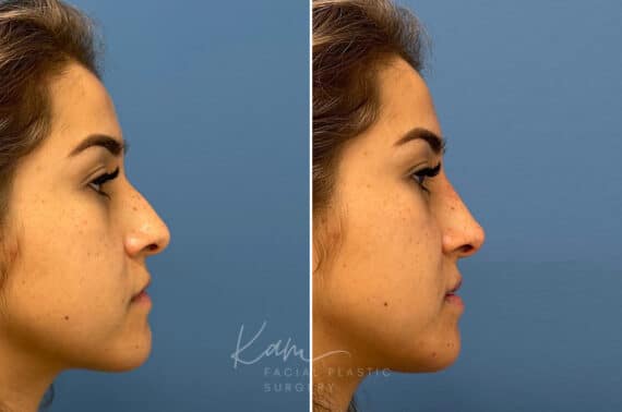 Liquid Rhinoplasty before and after photos in Voorhees, NJ, Patient 1884